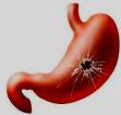 Ulcere gastrique